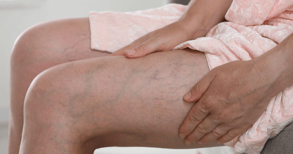 下肢静脈瘤の治療を考える目安になる症状
