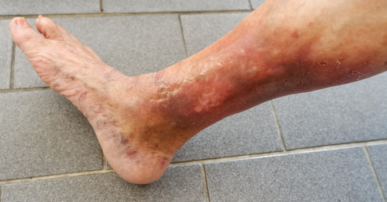 足首周辺の色素沈着や皮膚変化の例