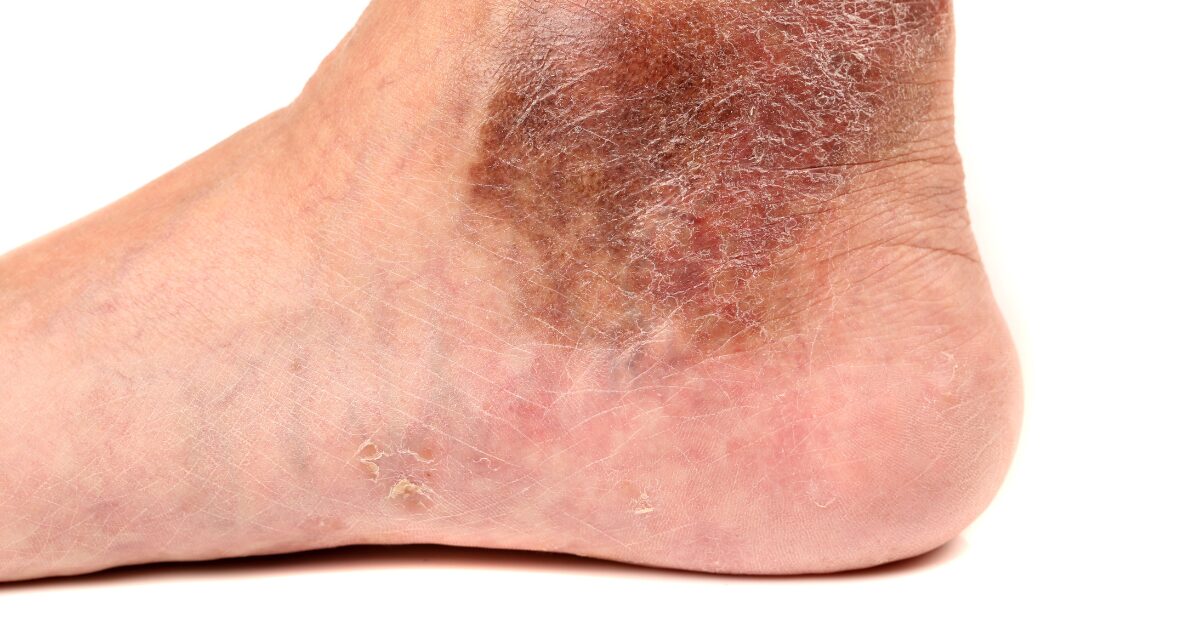 足首の皮膚に色素沈着やかさつきがみられる例