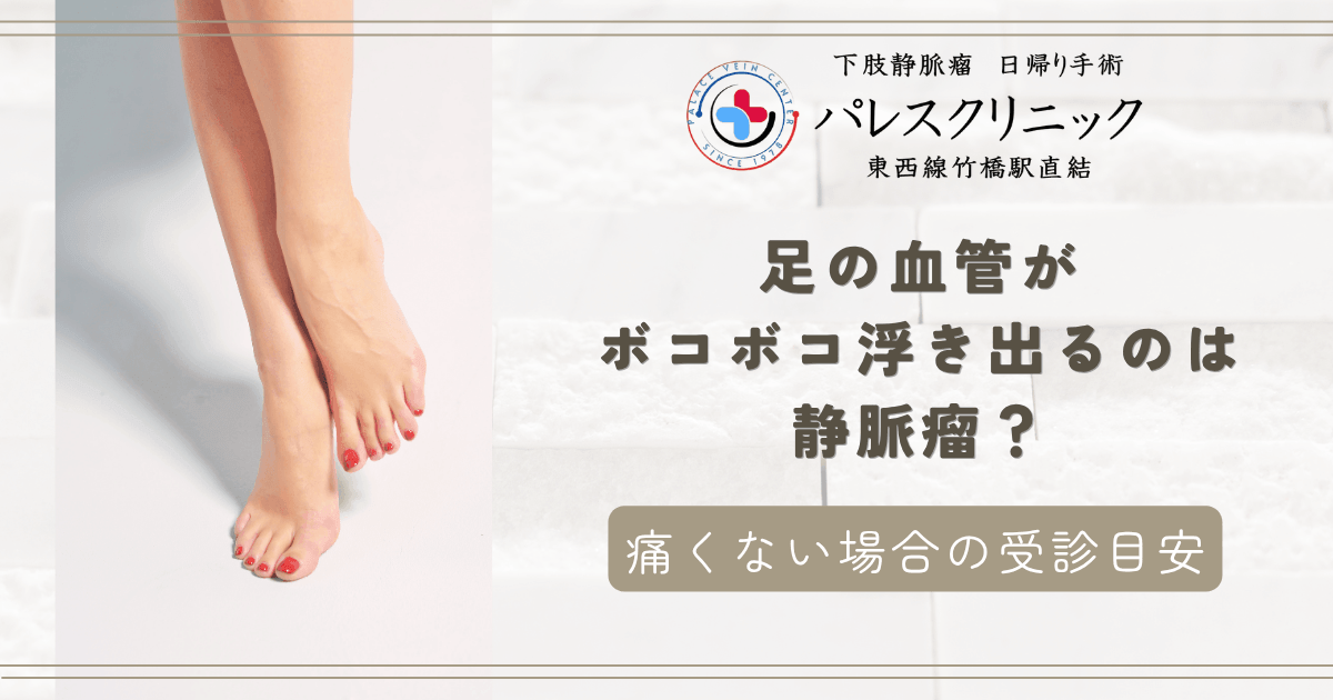 足の血管がボコボコ浮き出るのは静脈瘤？痛くない場合の受診目安