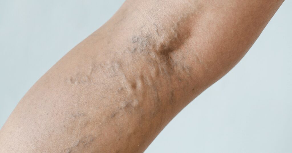 足の血管がボコボコしている場合に受診を考える目安