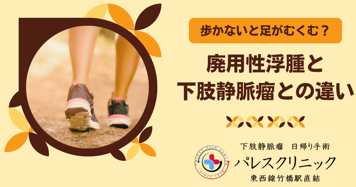 歩かないと足がむくむ？廃用性浮腫と下肢静脈瘤との違い