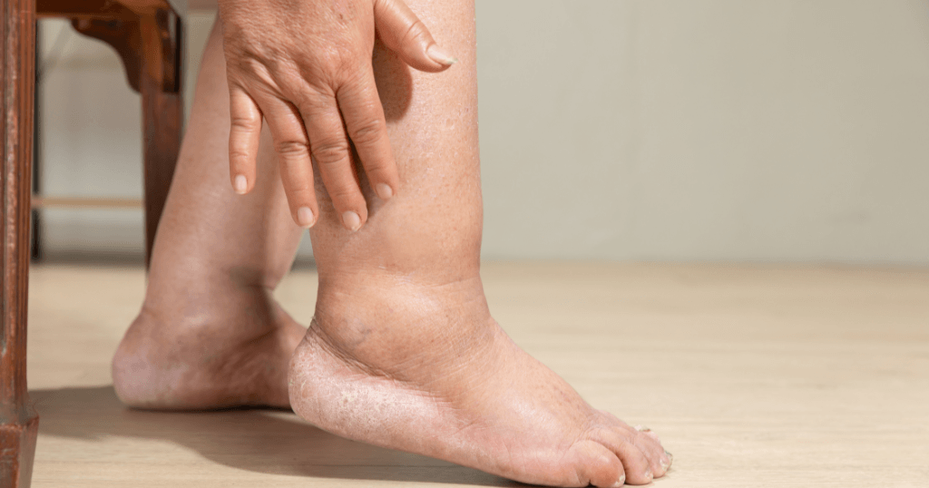 歩かないと足がむくむ「廃用性浮腫」とは？