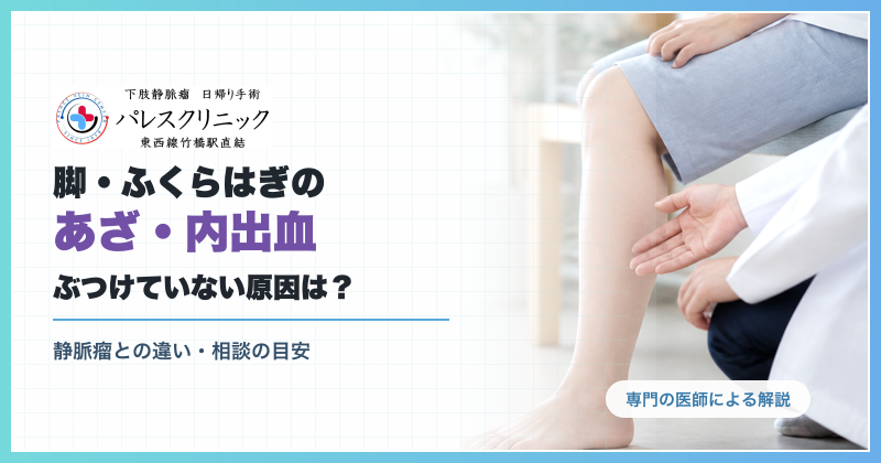 ぶつけていない脚・ふくらはぎのあざと下肢静脈瘤との違いを専門の医師が解説する記事のアイキャッチ画像