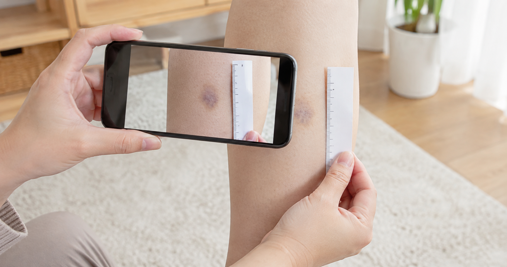脚のあざをスマートフォンと定規で記録している様子