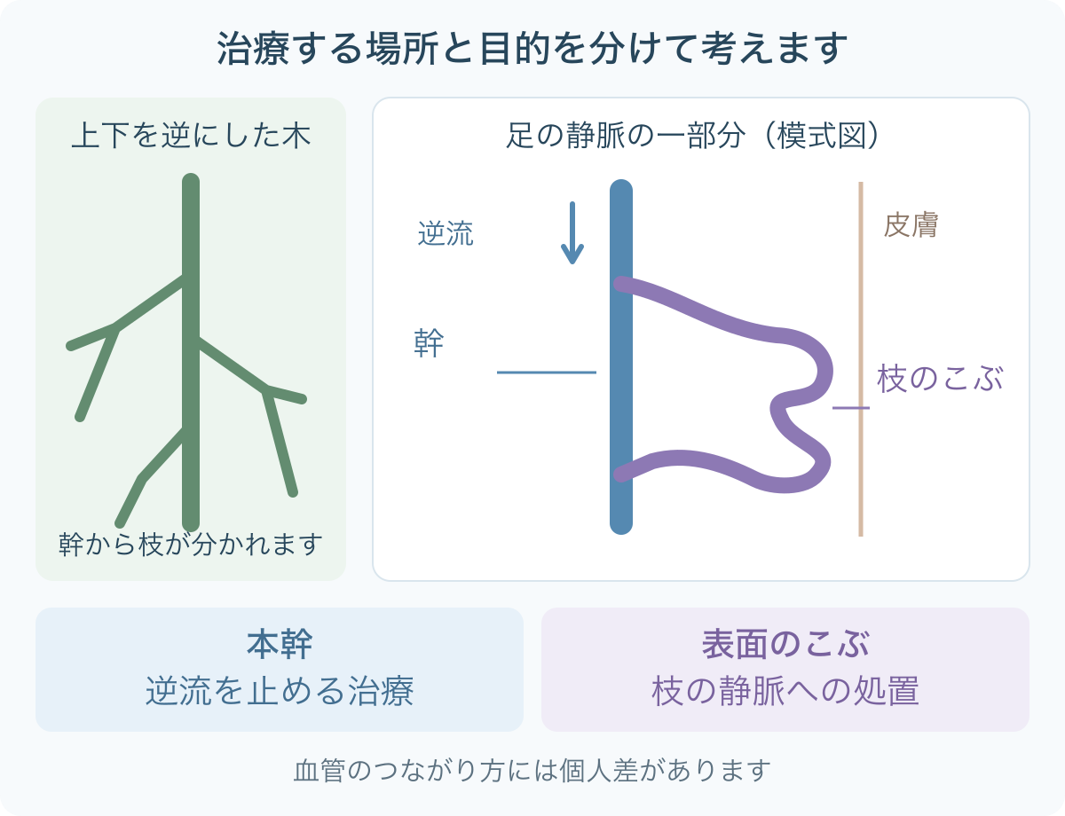 伏在静脈の本幹と、表面に浮き出た枝の静脈瘤を分け、本幹の逆流を止める治療と枝への処置の役割を示す模式図